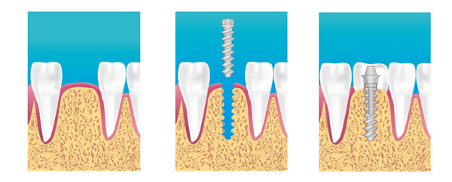 implant dentaire marseille 13012